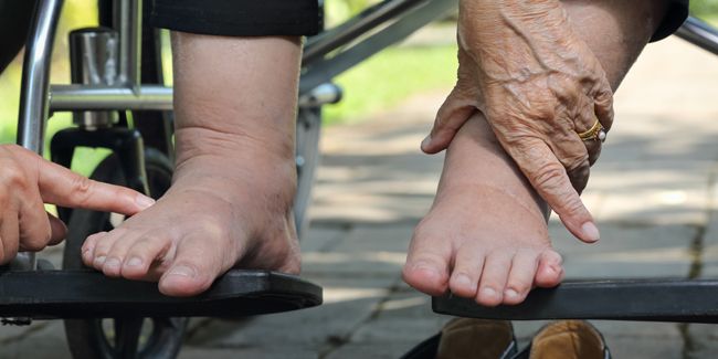 Pieds enflés chez les personnes âgées : comprendre et agir